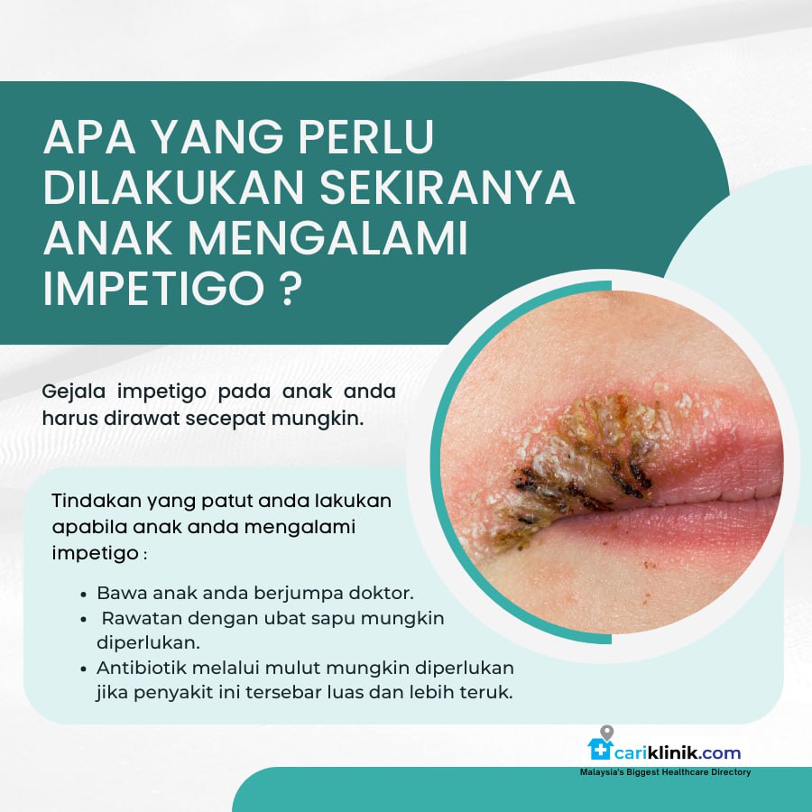 SEKIRANYA ANAK MENGALAMI IMPETIGO, APA YANG PERLU DILAKUKAN ?