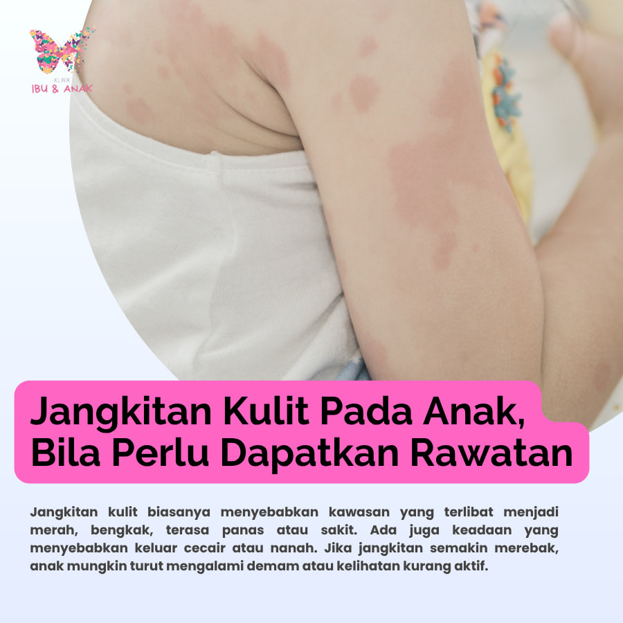 JANGKITAN KULIT  PADA ANAK, BILA PERLU DAPATKAN RAWATAN